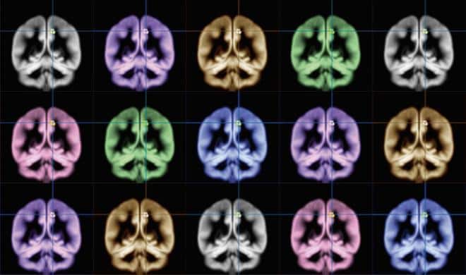 La dimensione del precuneus può influenzare la felicità. Le scansioni MRI. Sato, et al, Scientific Reports