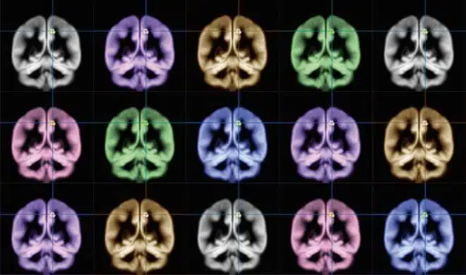 La dimensione del precuneus può influenzare la felicità. Le scansioni MRI. Sato, et al, Scientific Reports